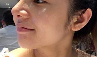 驼峰鼻价格 驼峰鼻价格