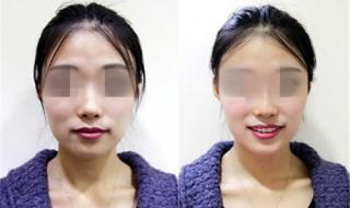 整形鼻子需要多少钱